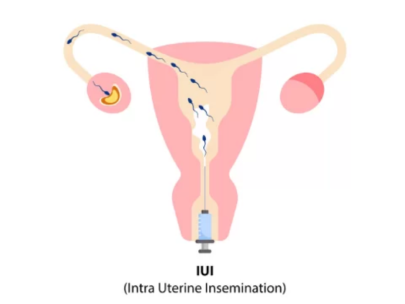 IUI — Intrauterine Insemination — Healia Women’s Health, Dubai