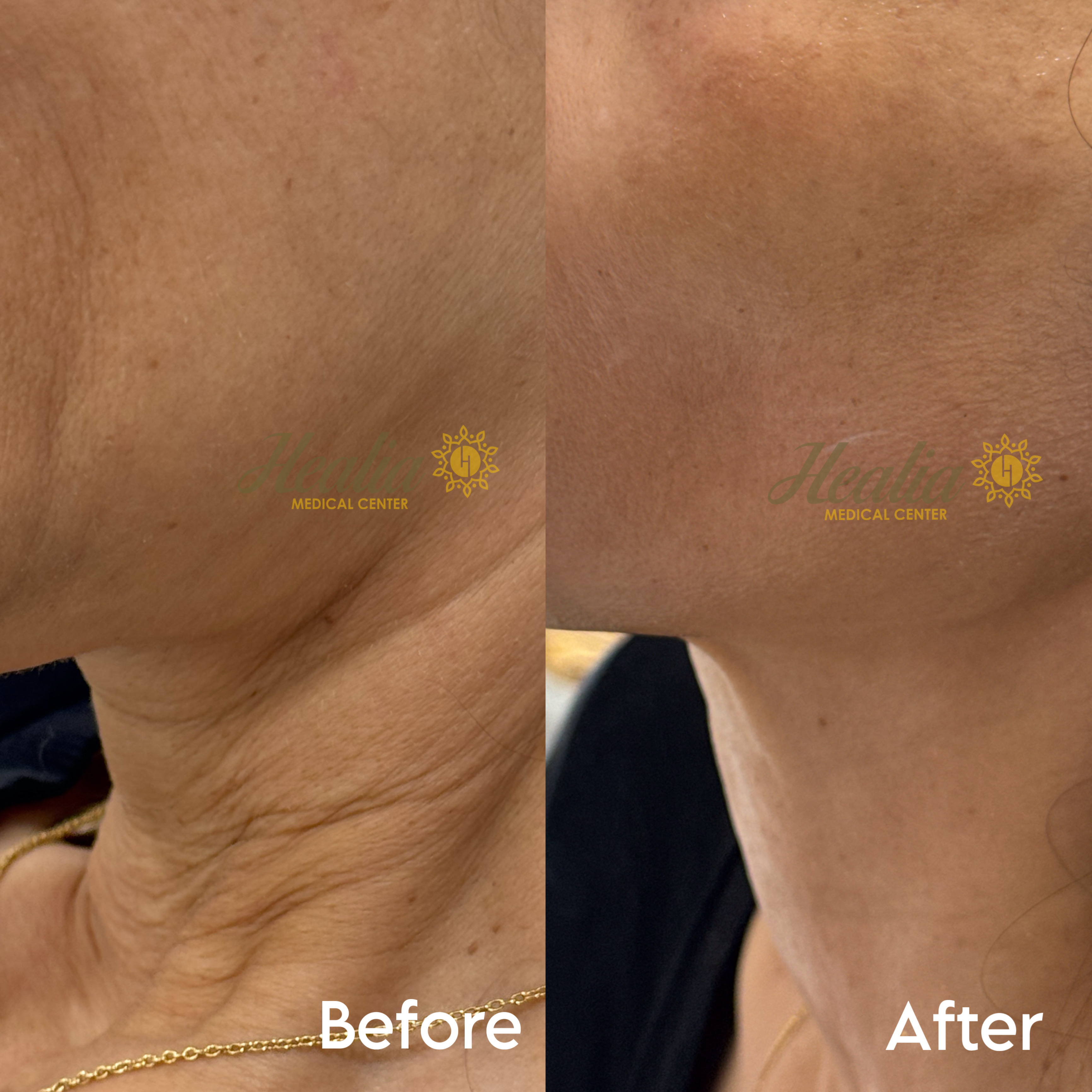 Endolift