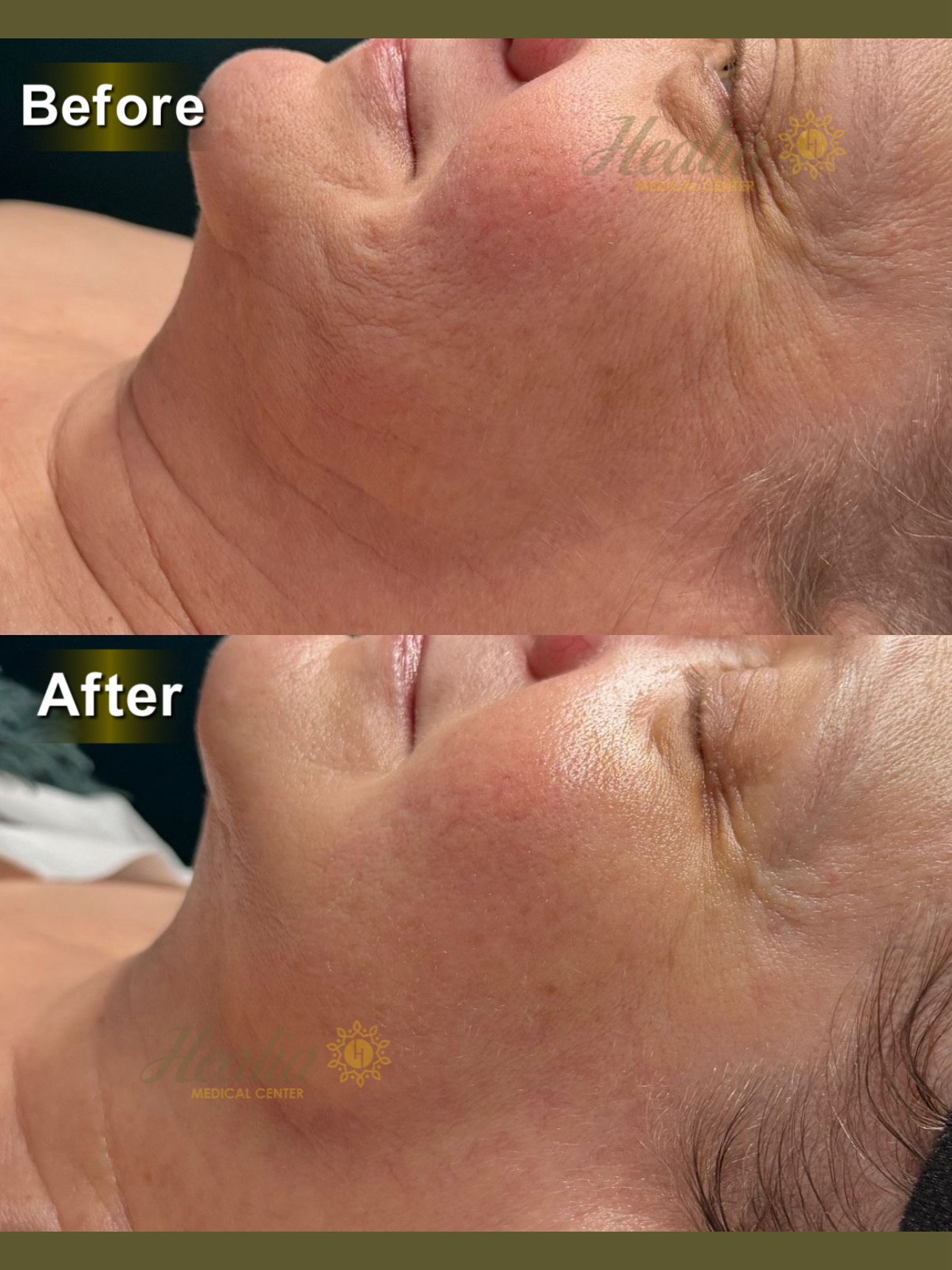 Endolift