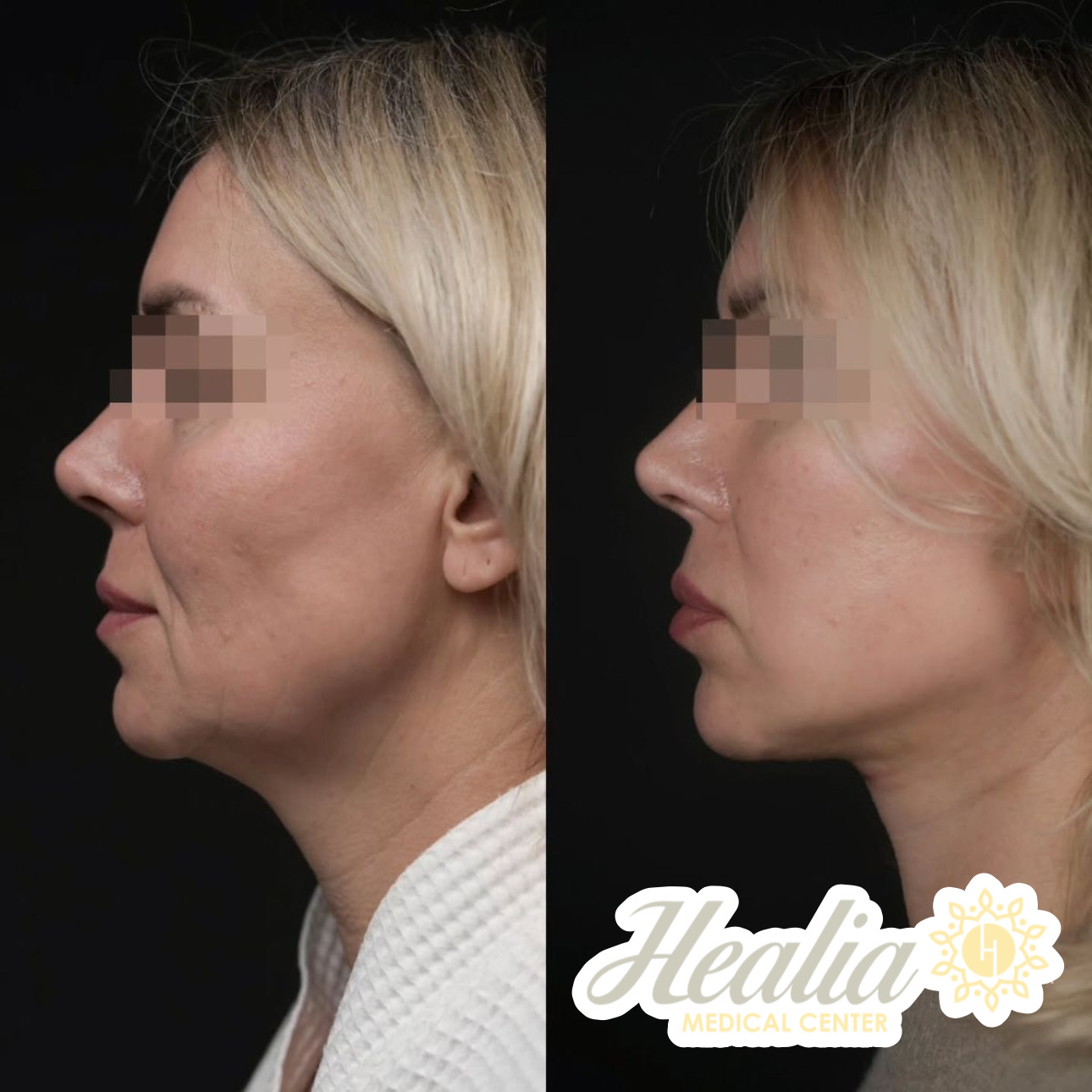 Endolift