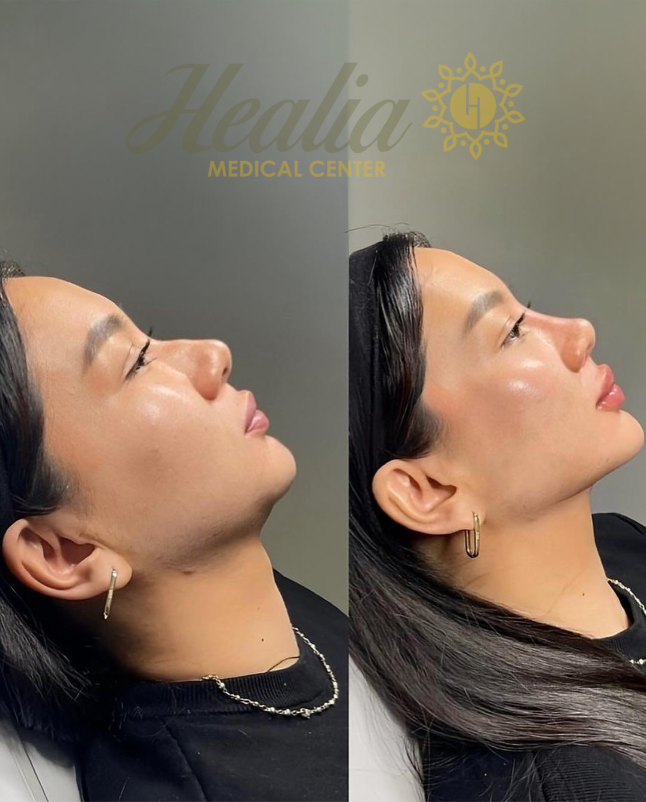 Endolift