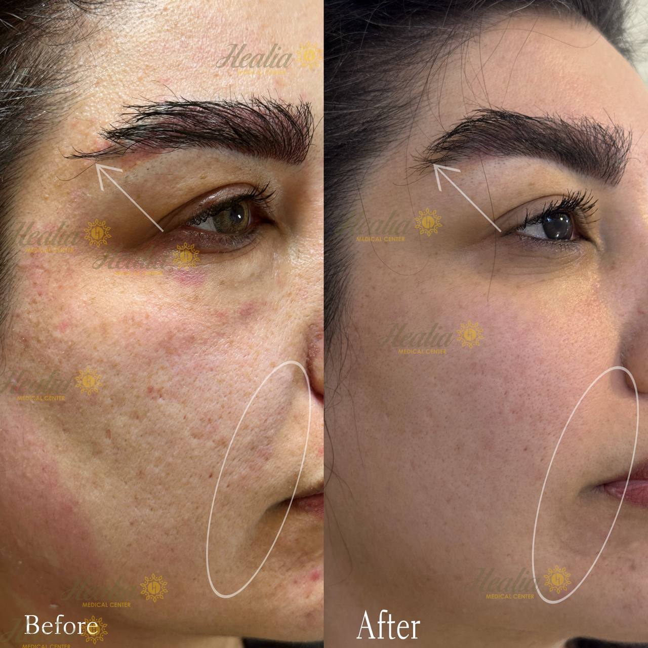 Eyelid Rejuvenation