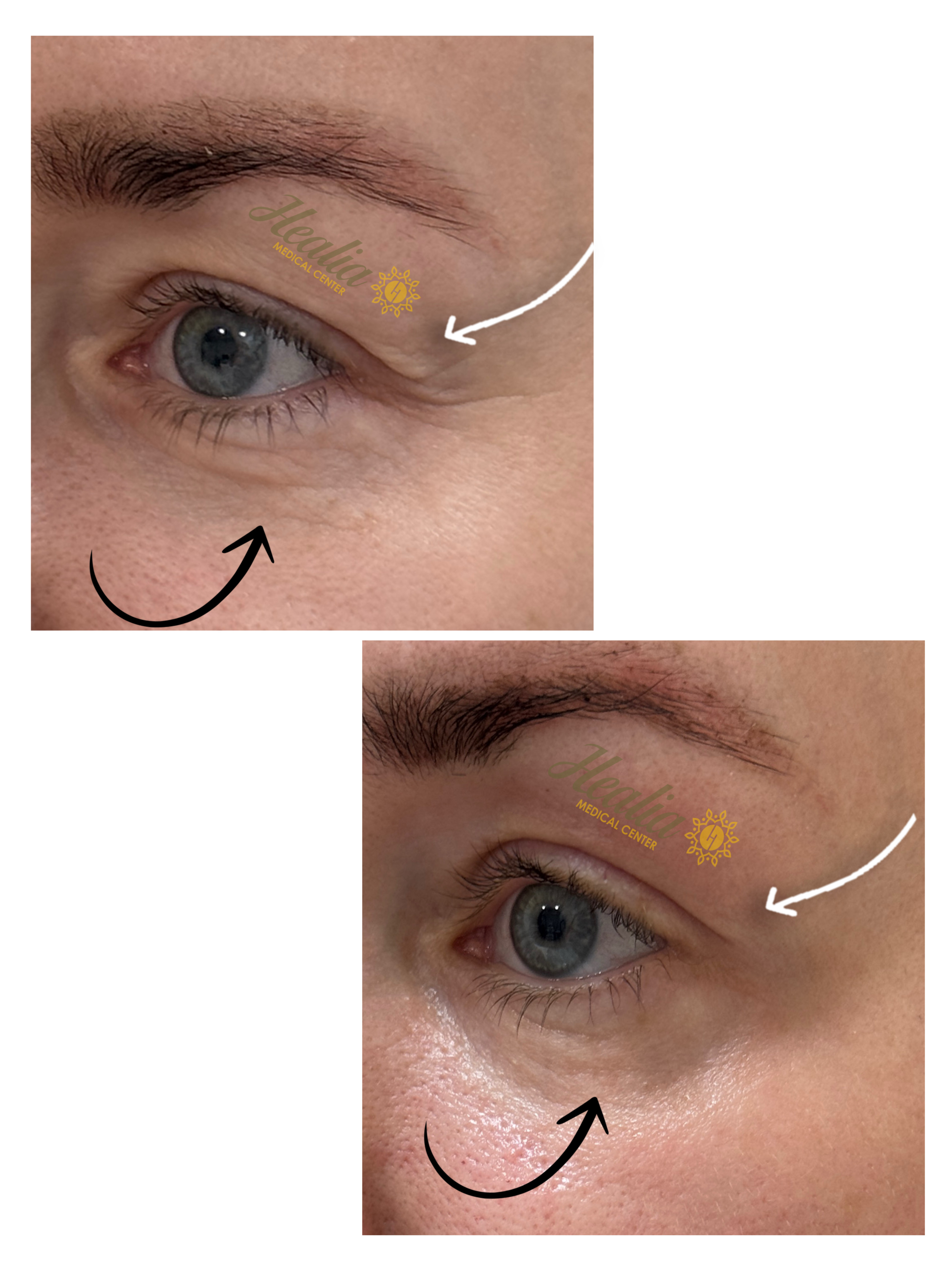 Eyelid Rejuvenation