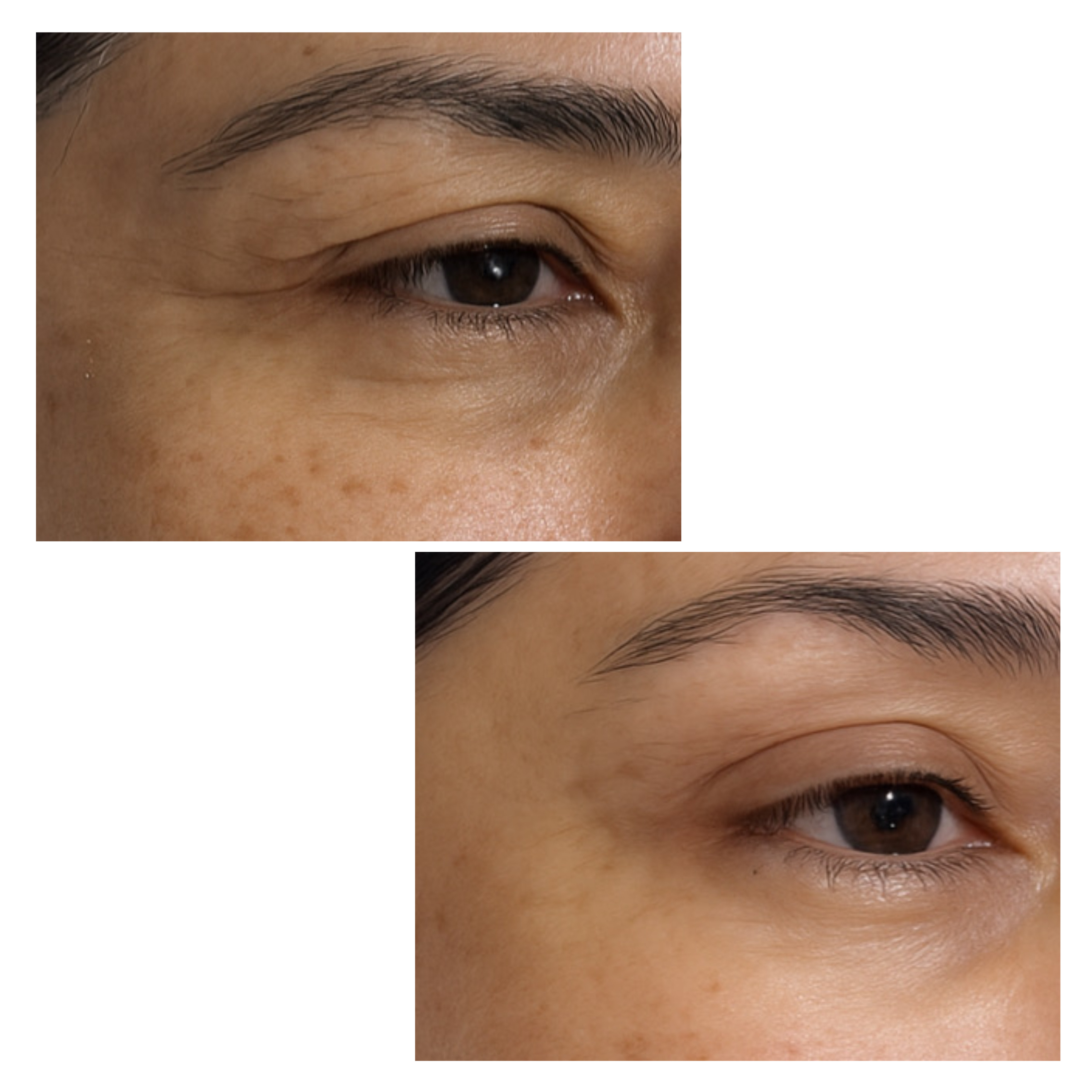 Eyelid Rejuvenation