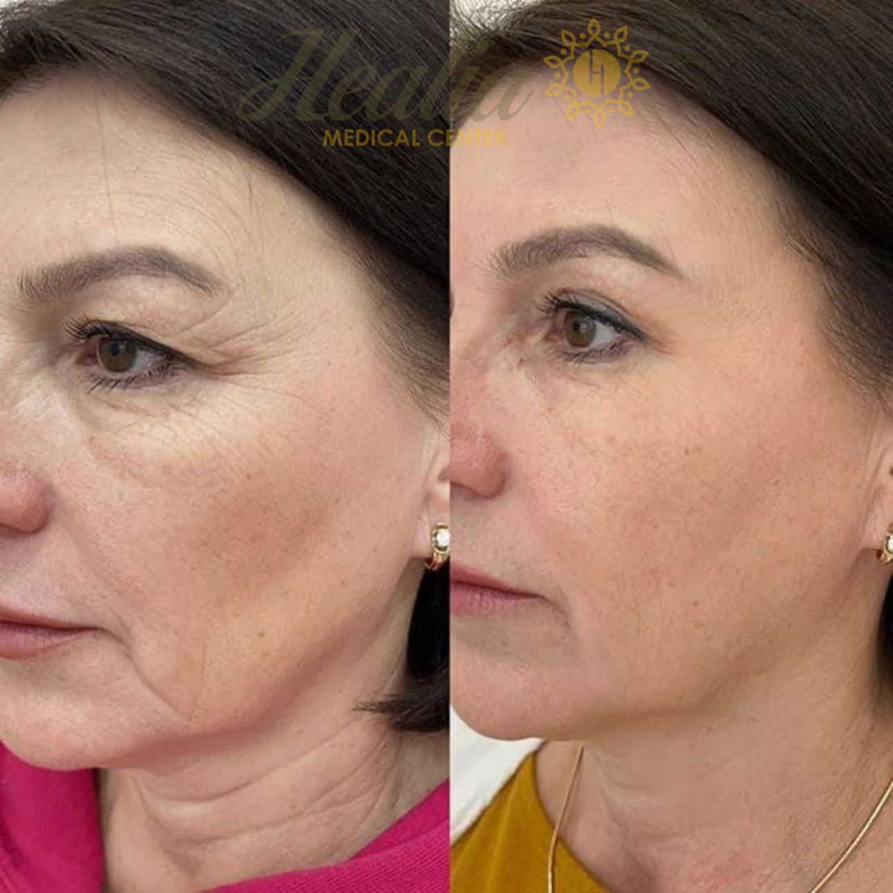 Eyelid Rejuvenation