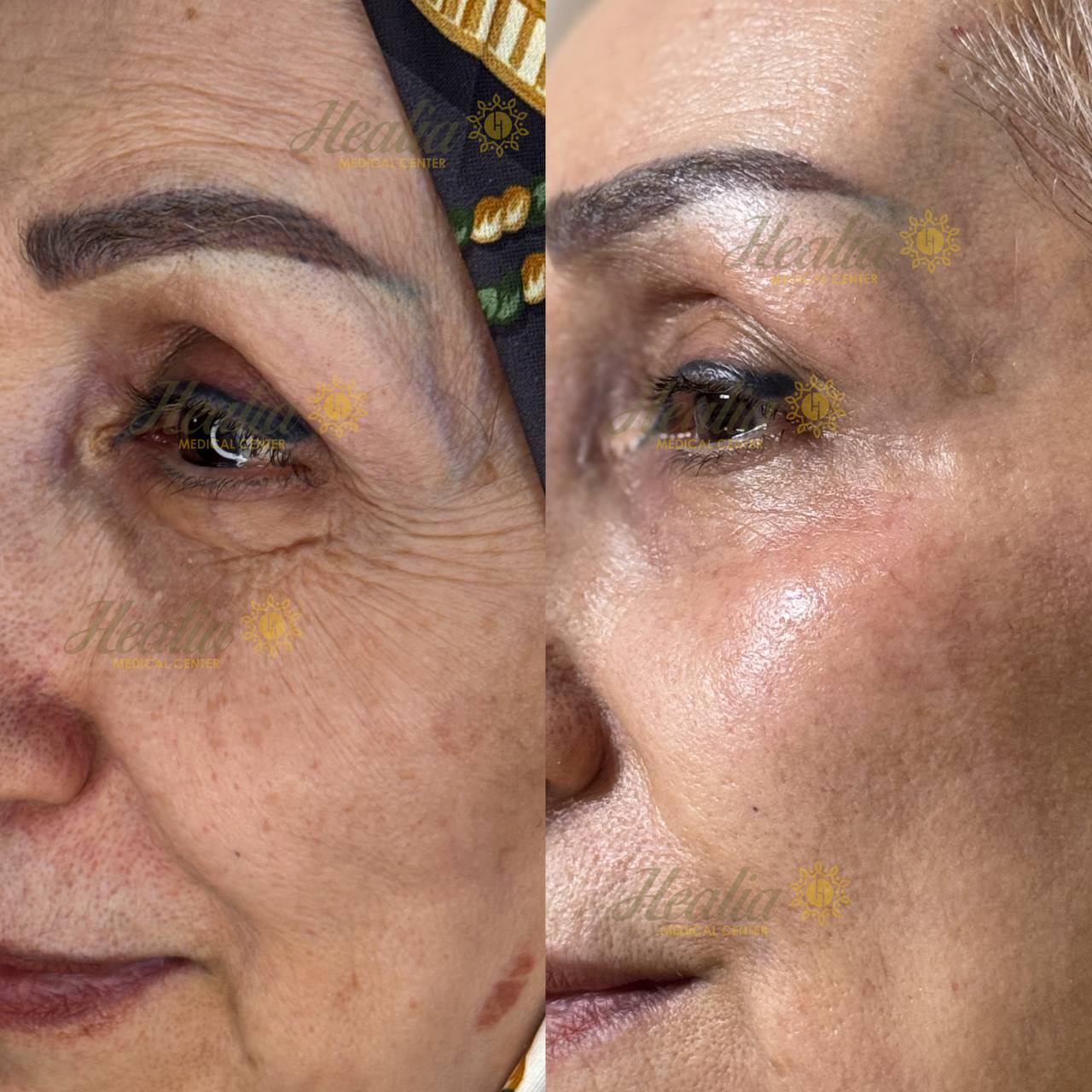 Eyelid Rejuvenation