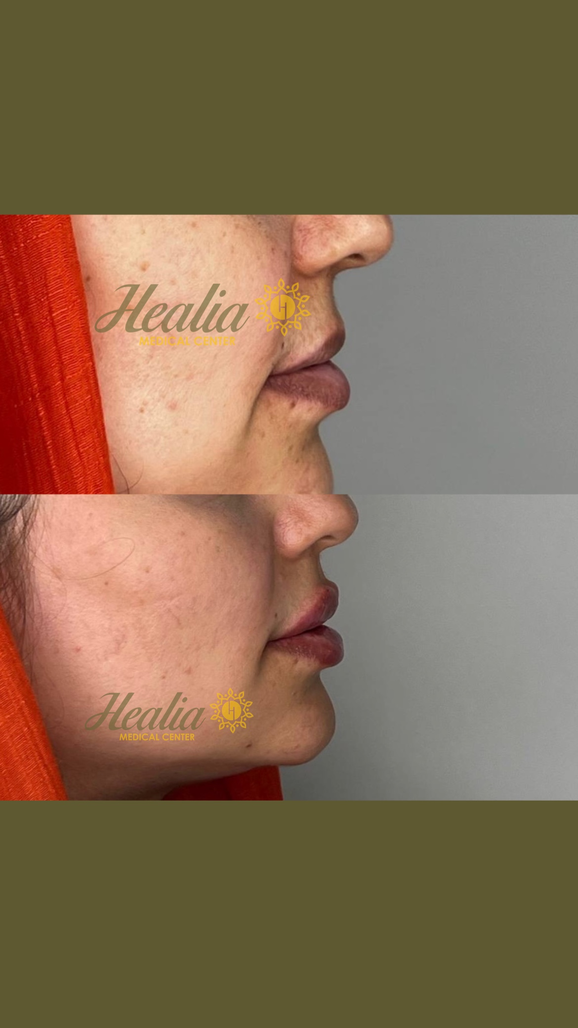 Face Filler