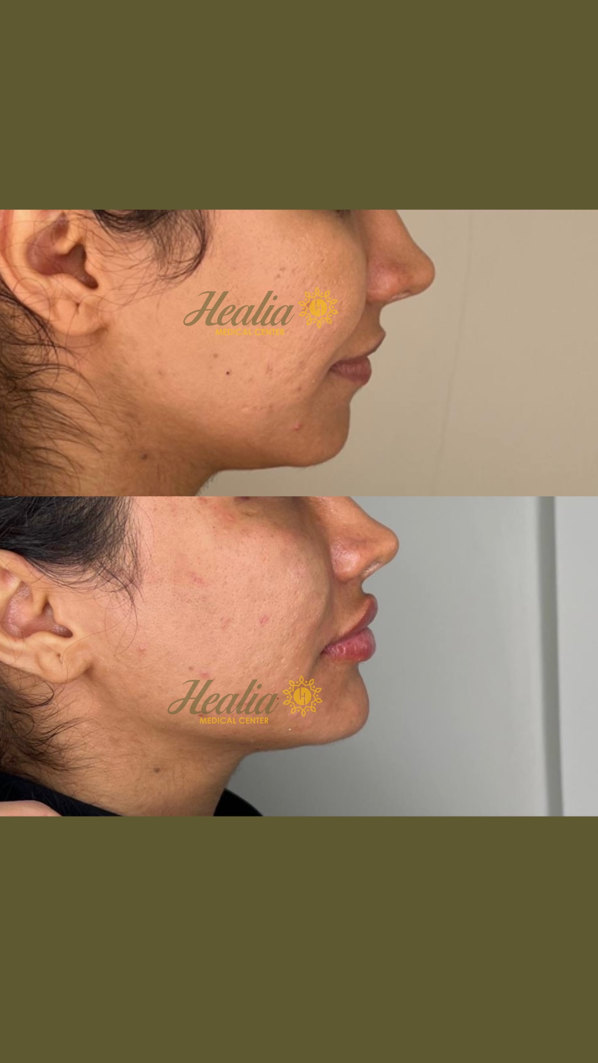 Face Filler