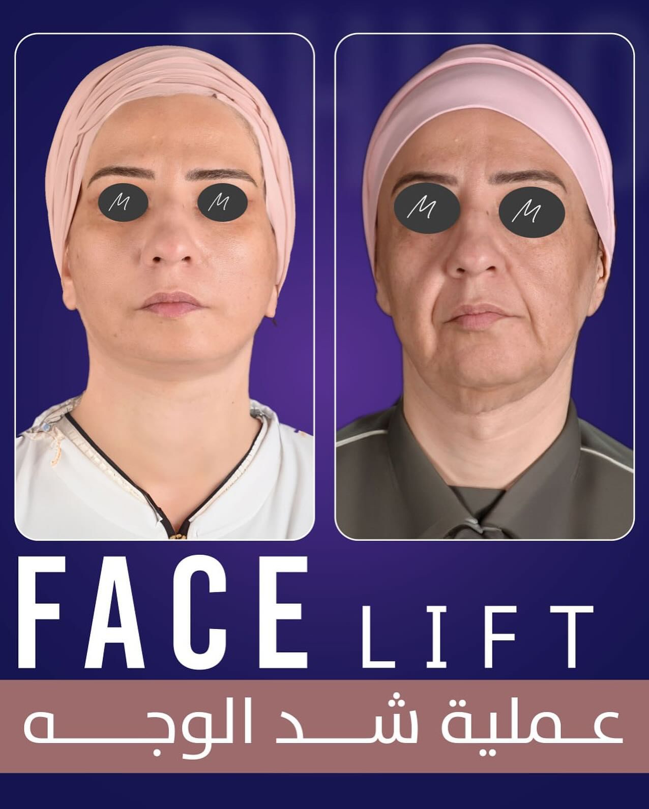 Face Lift
