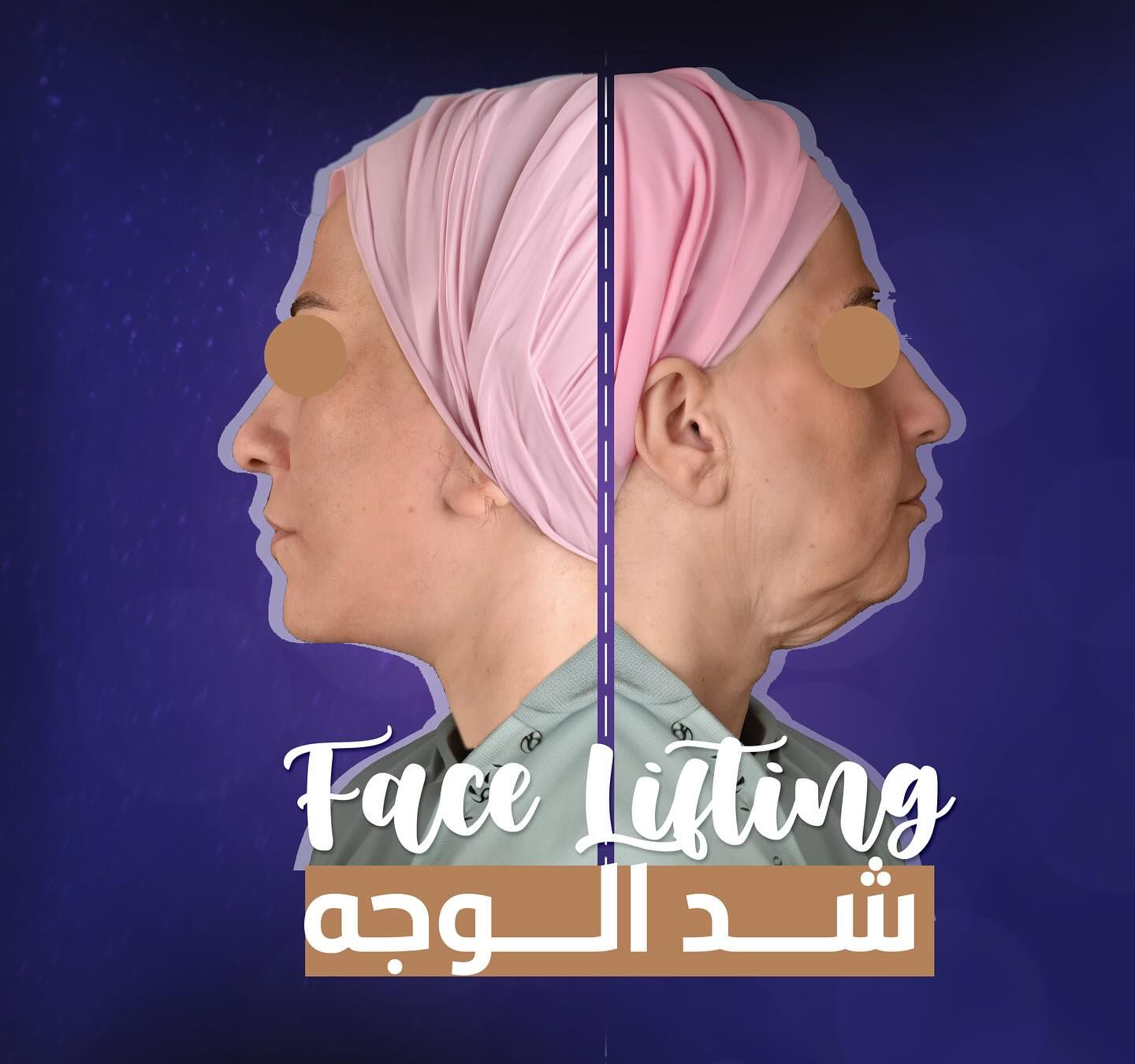 Face Lift