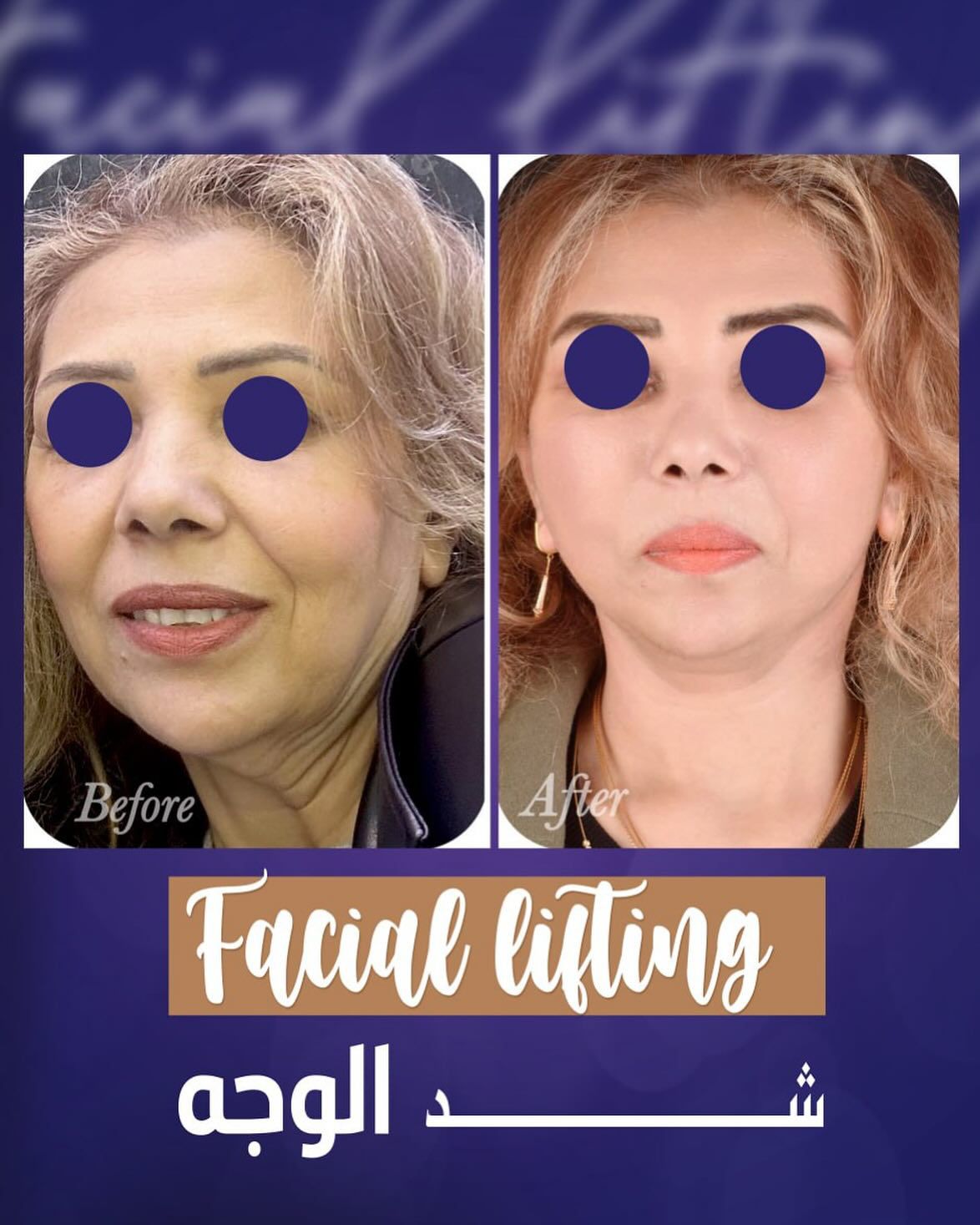 Face Lift