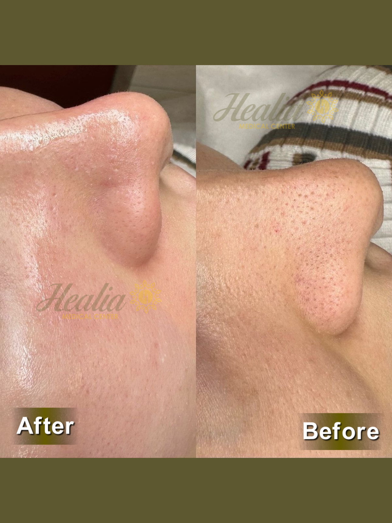 Facial