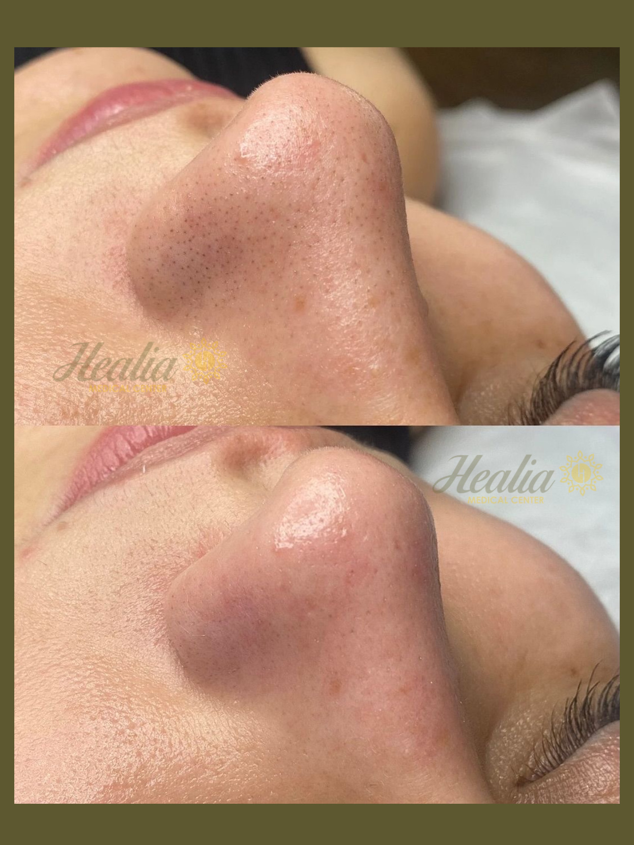 Facial