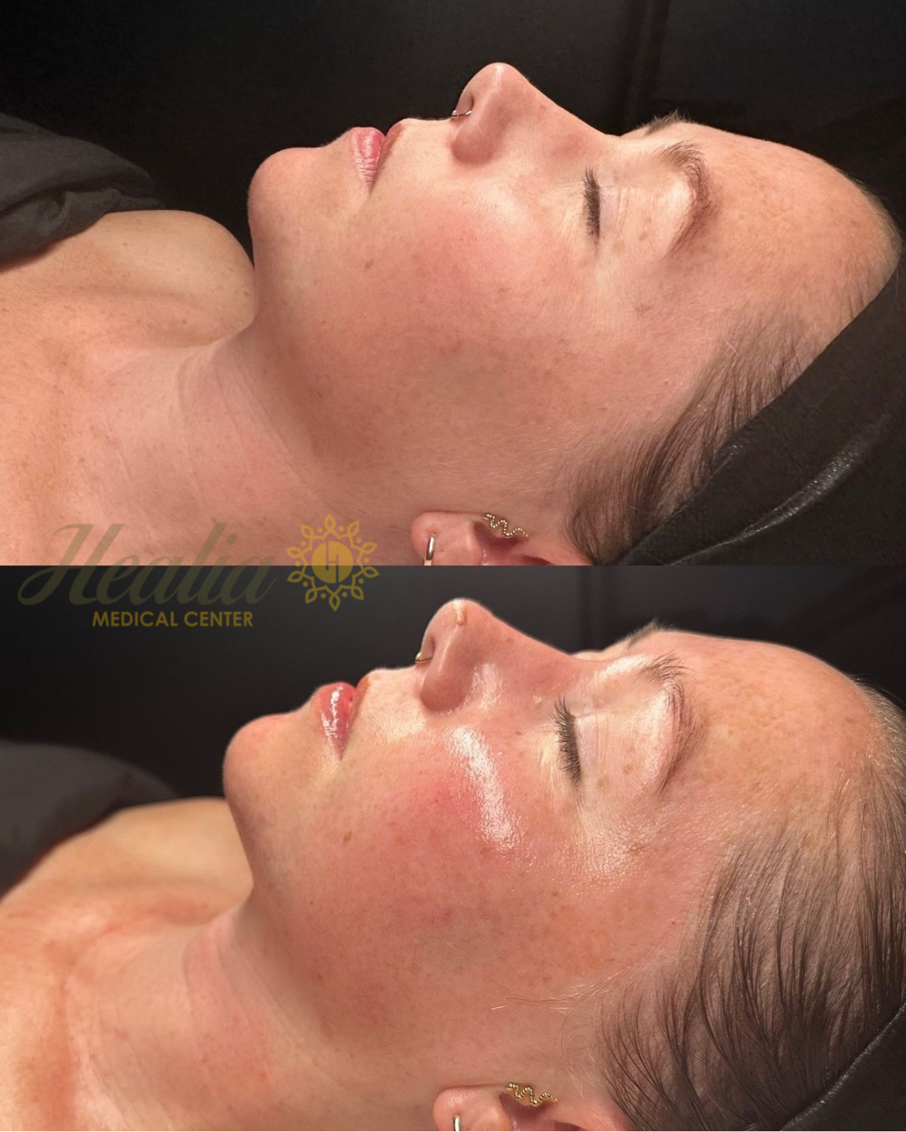 Facial