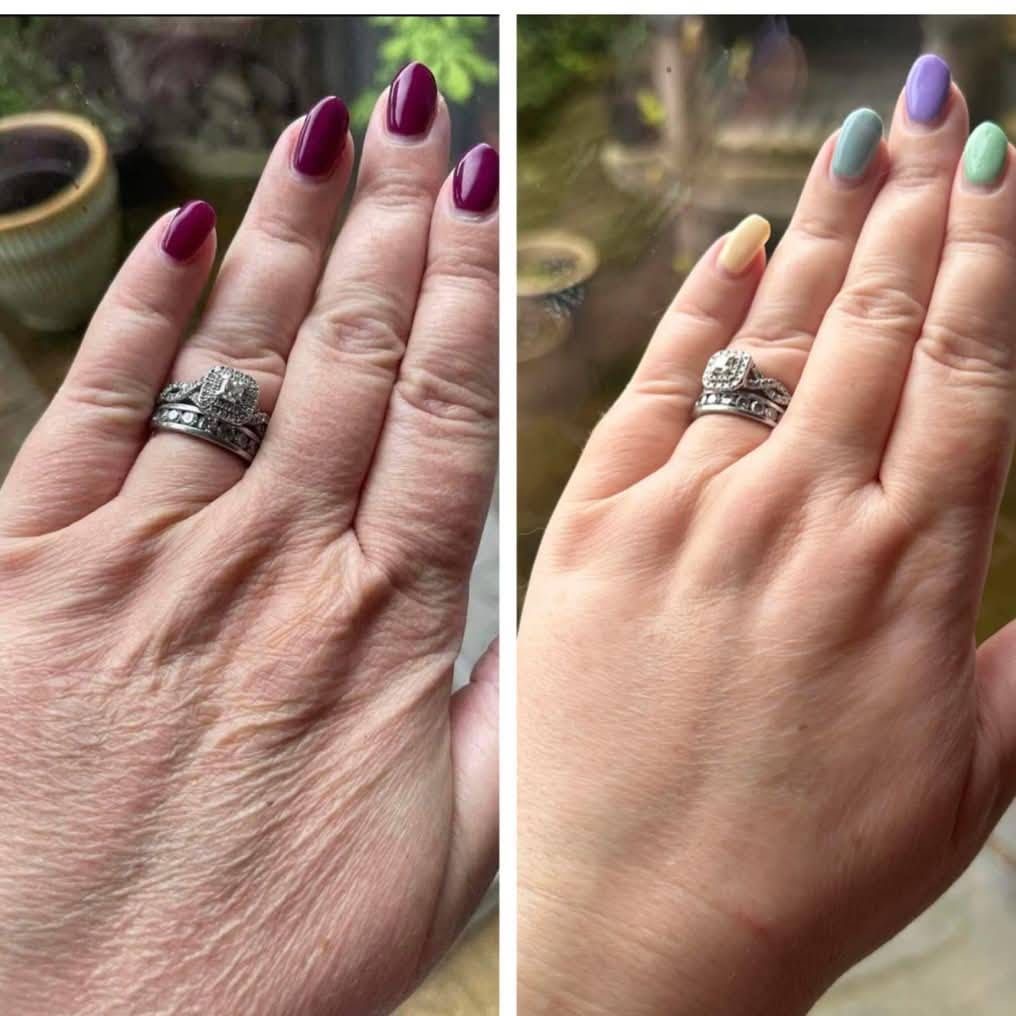 Hand Rejuvenation