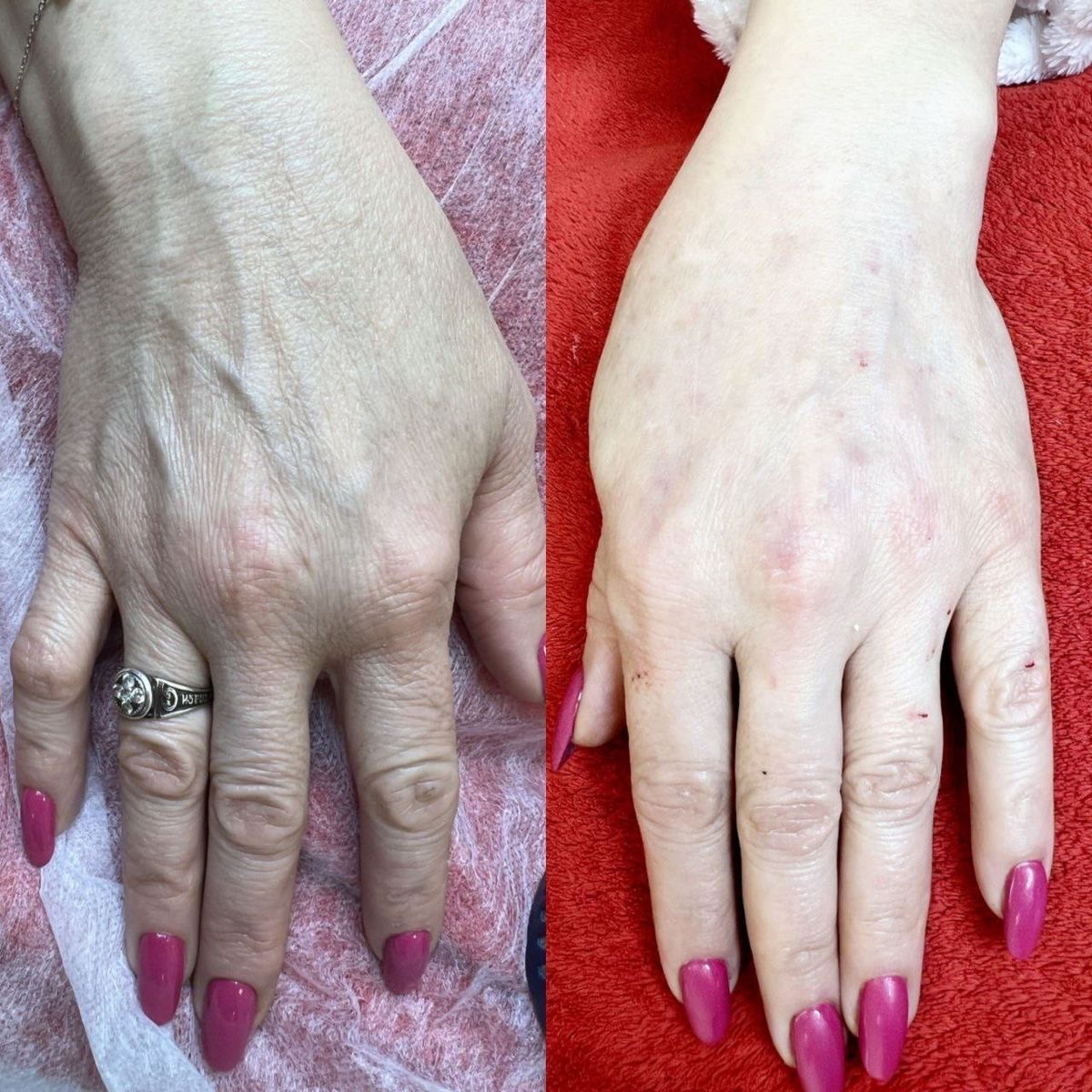 Hand Rejuvenation