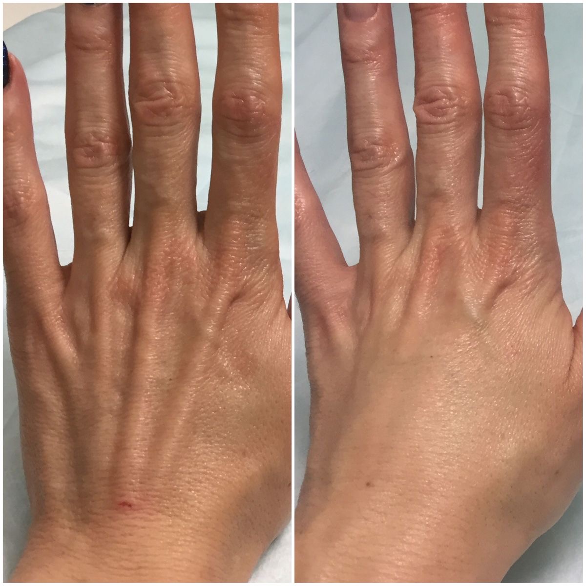 Hand Rejuvenation