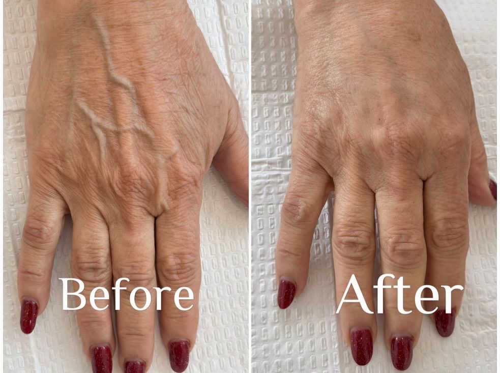 Hand Rejuvenation