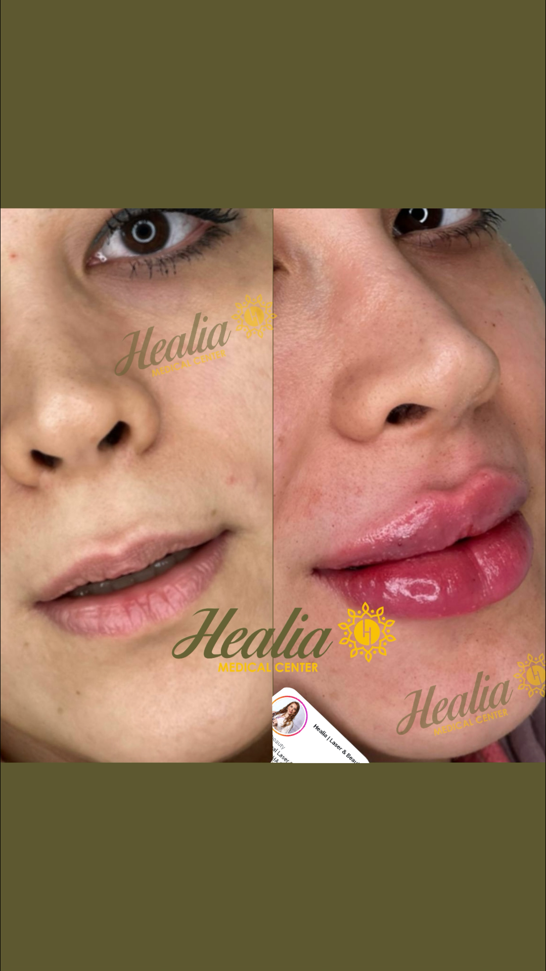Lip Filler