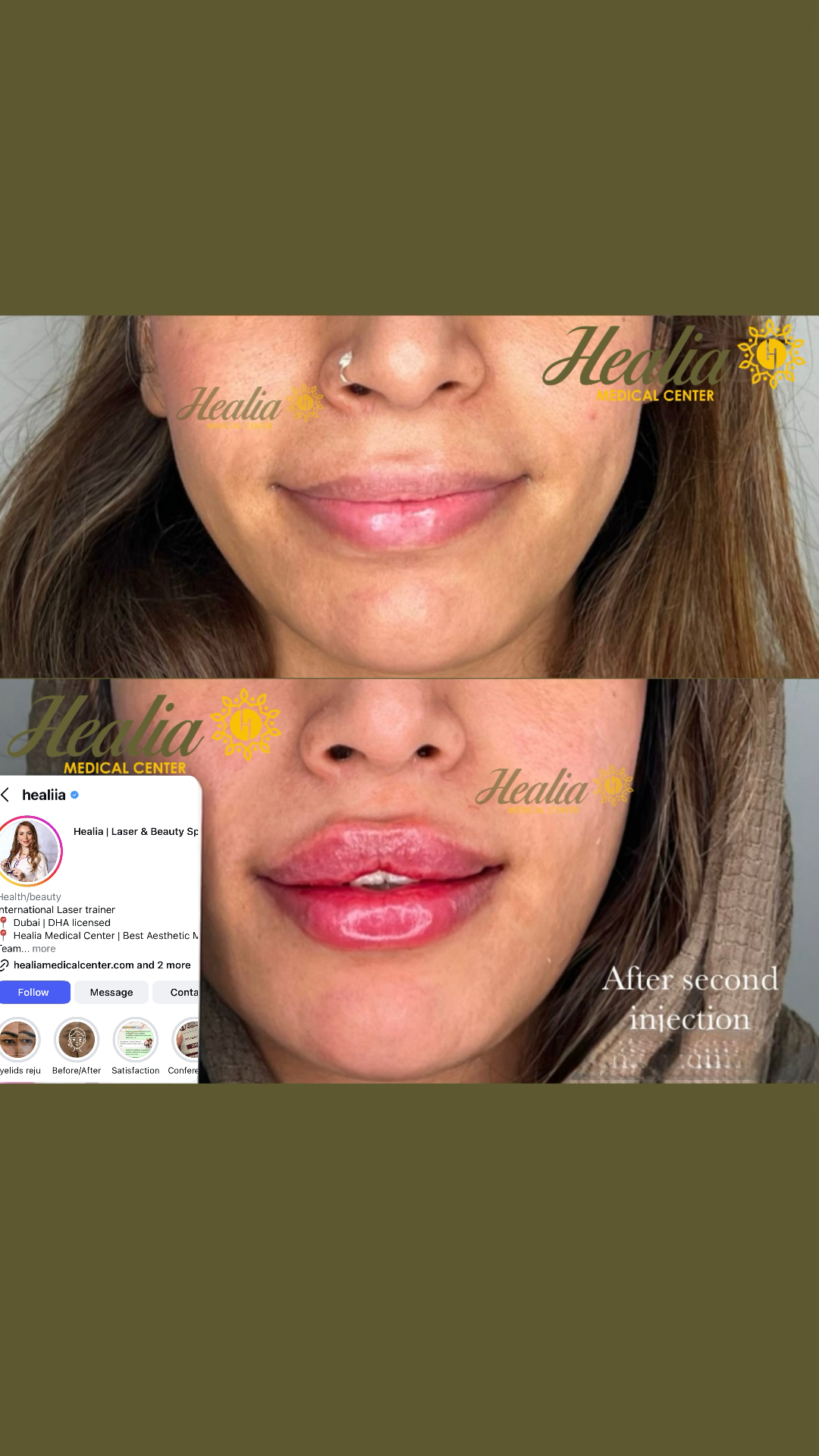 Lip Filler