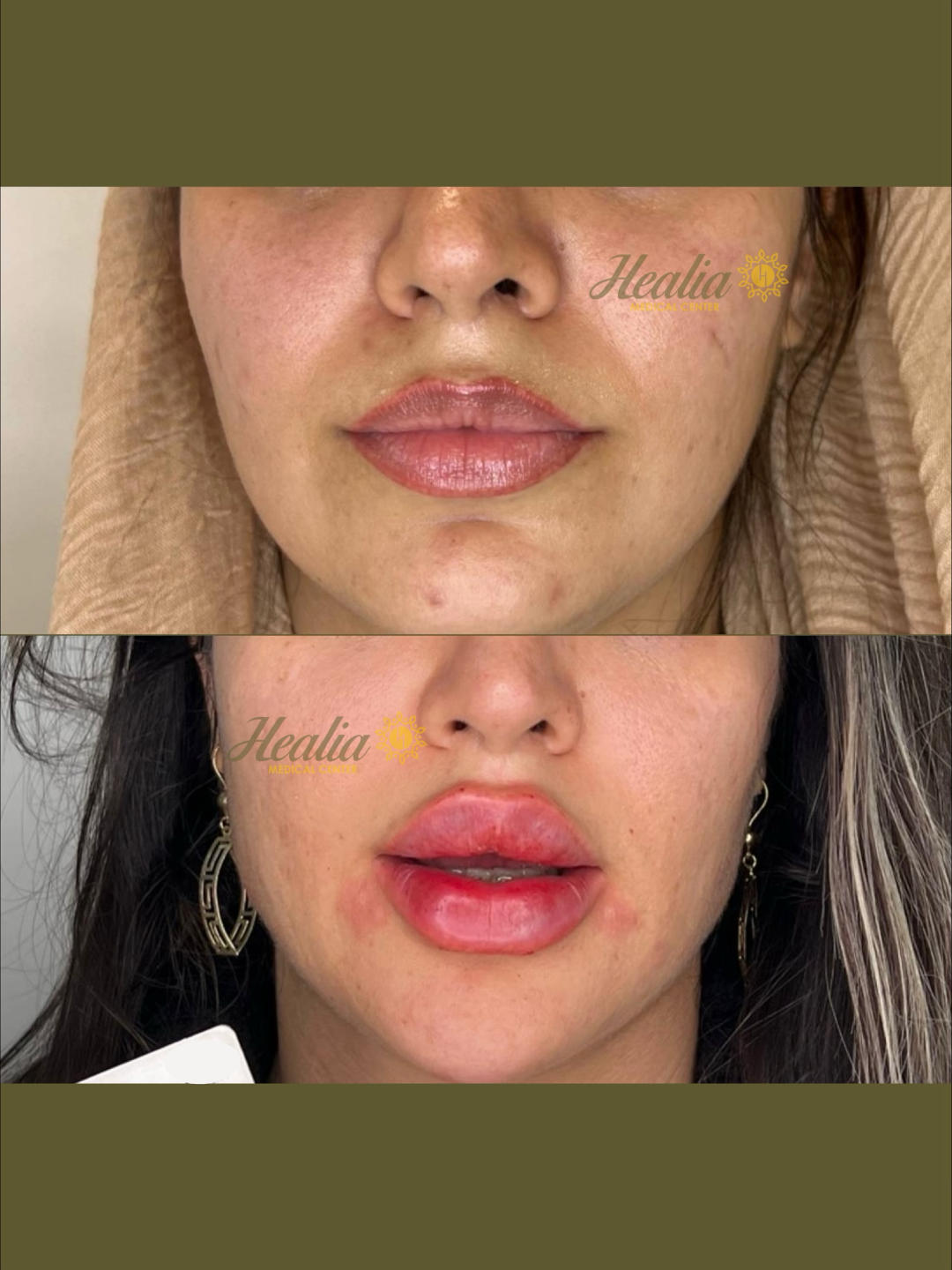Lip Filler
