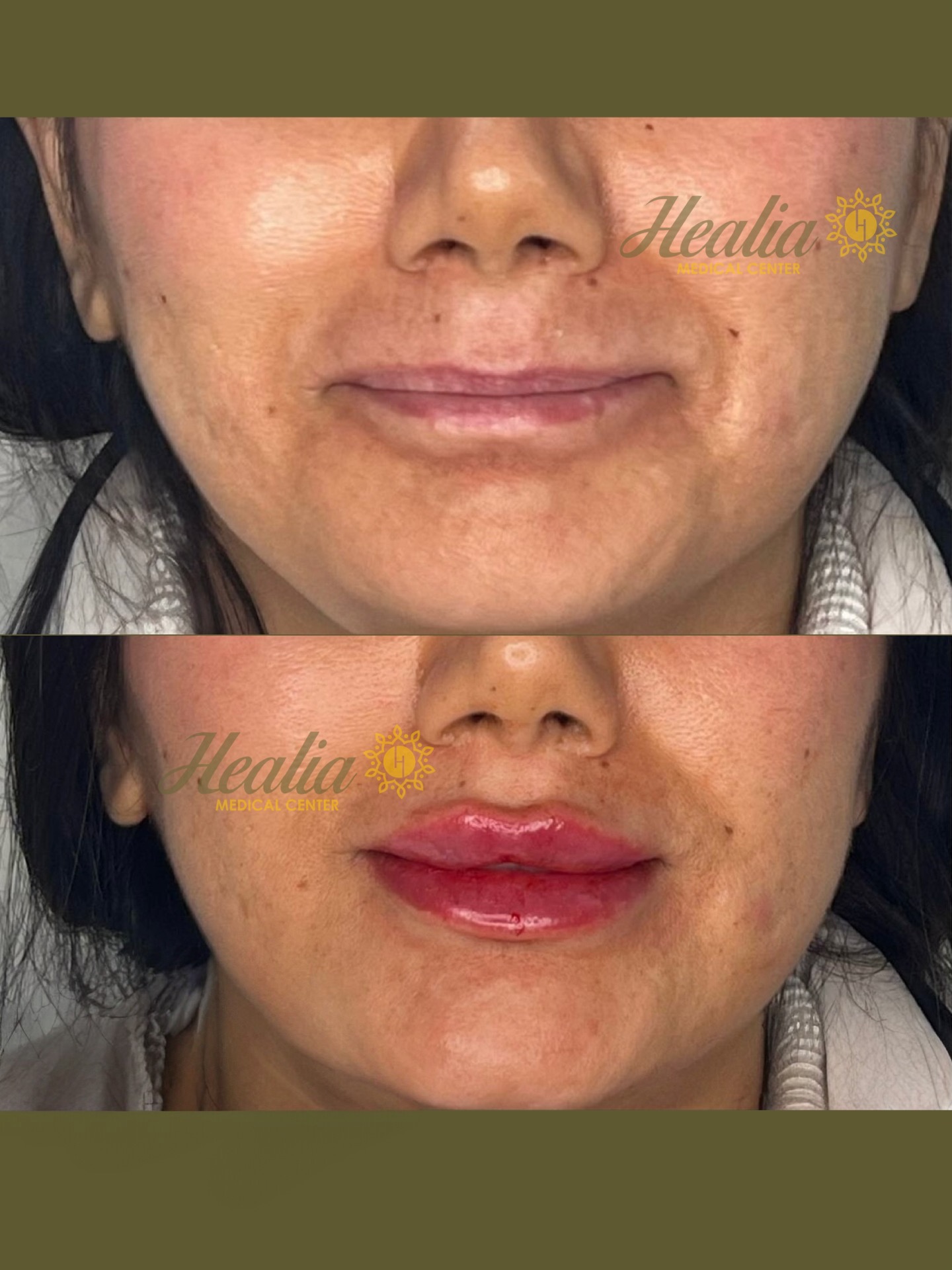 Lip Filler