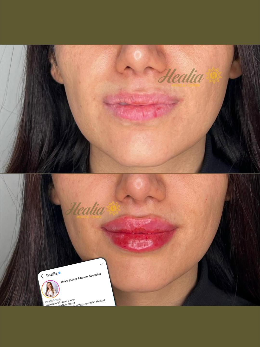 Lip Filler
