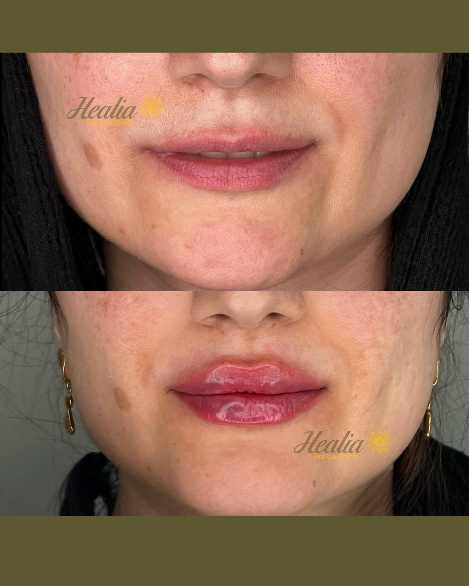 Lip Filler