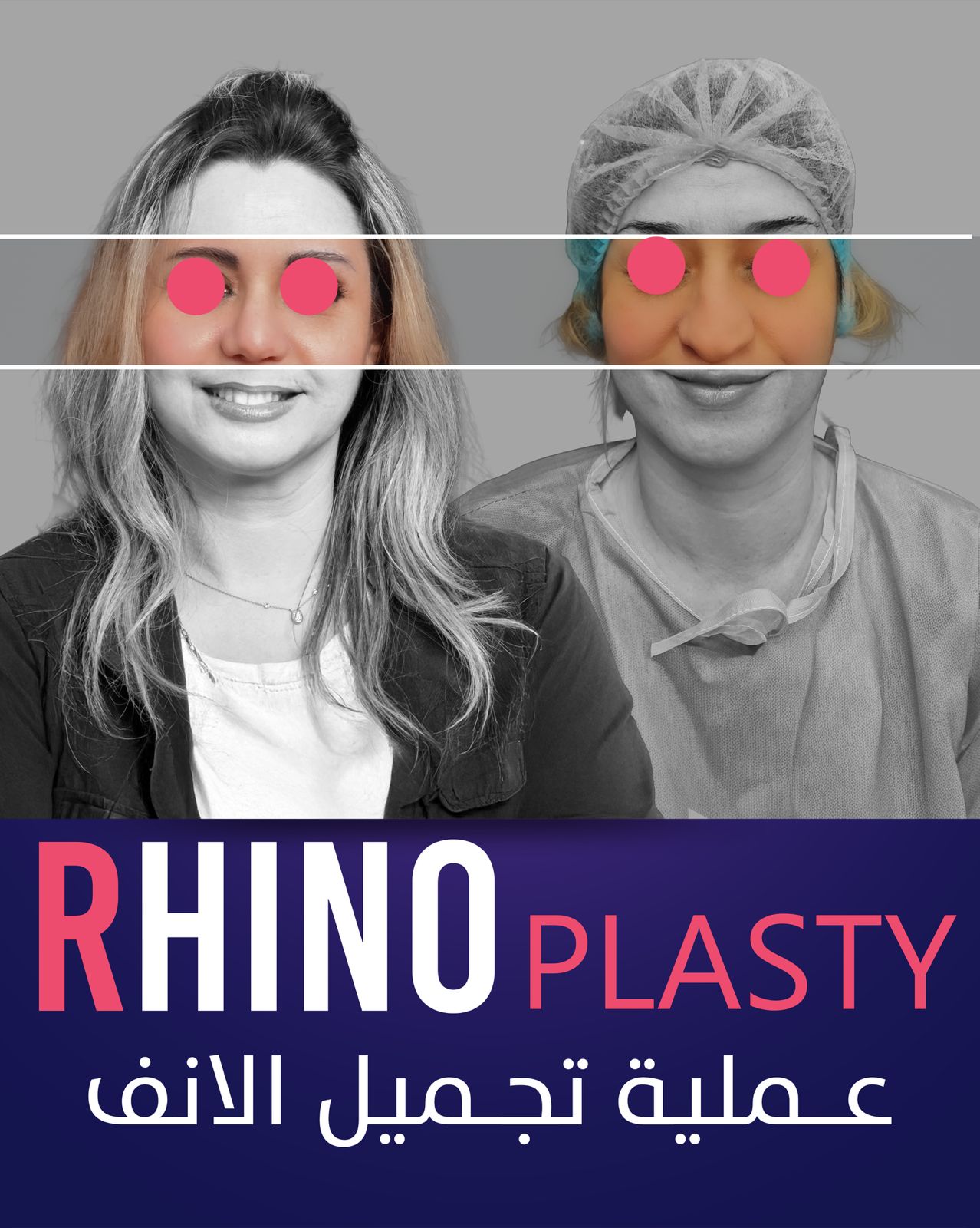 Rhinoplasty