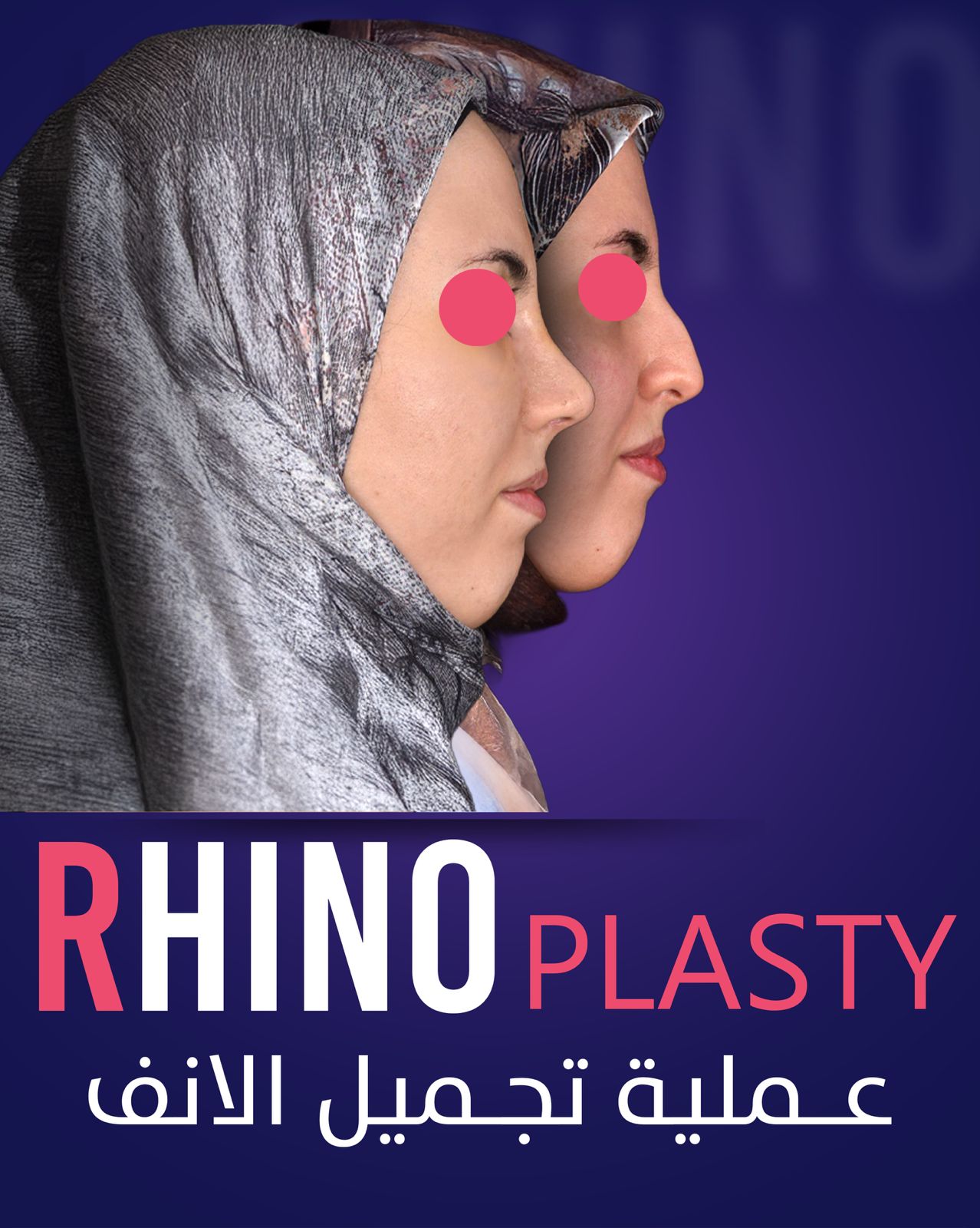 Rhinoplasty