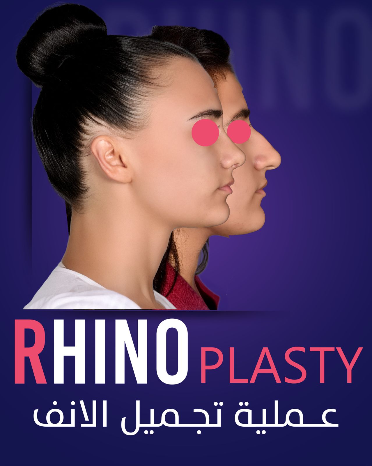 Rhinoplasty