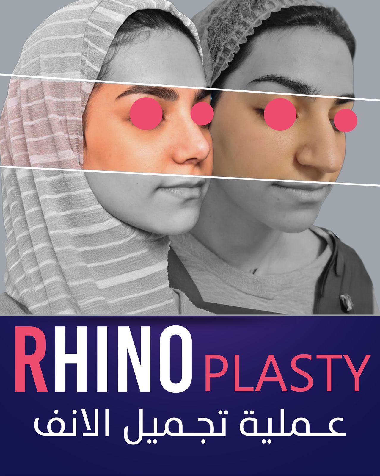 Rhinoplasty