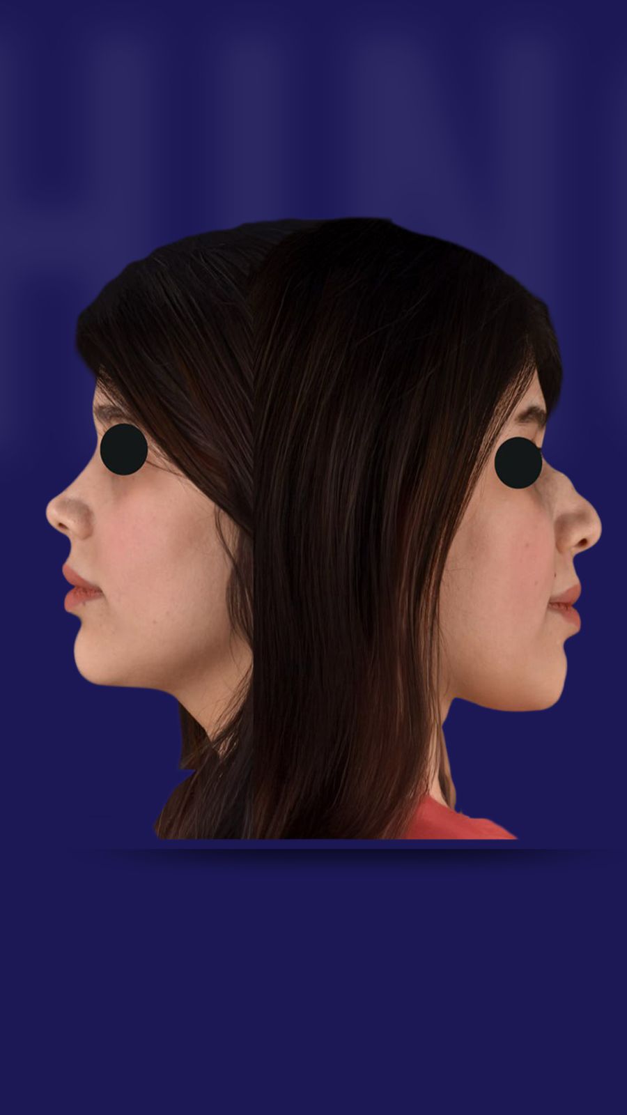 Rhinoplasty
