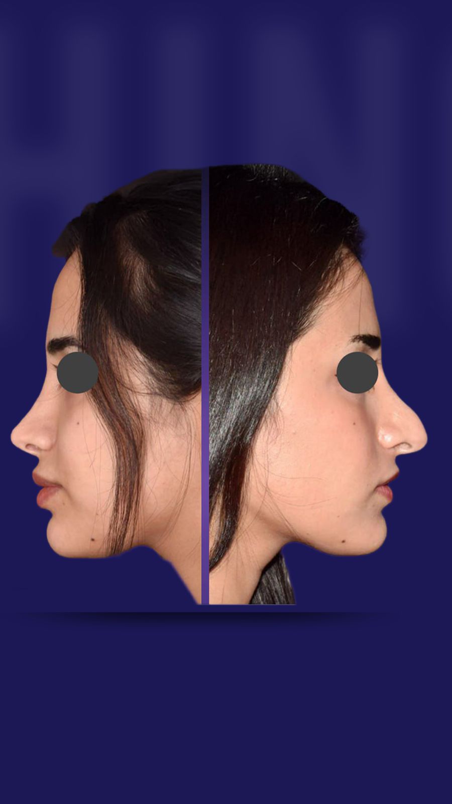 Rhinoplasty