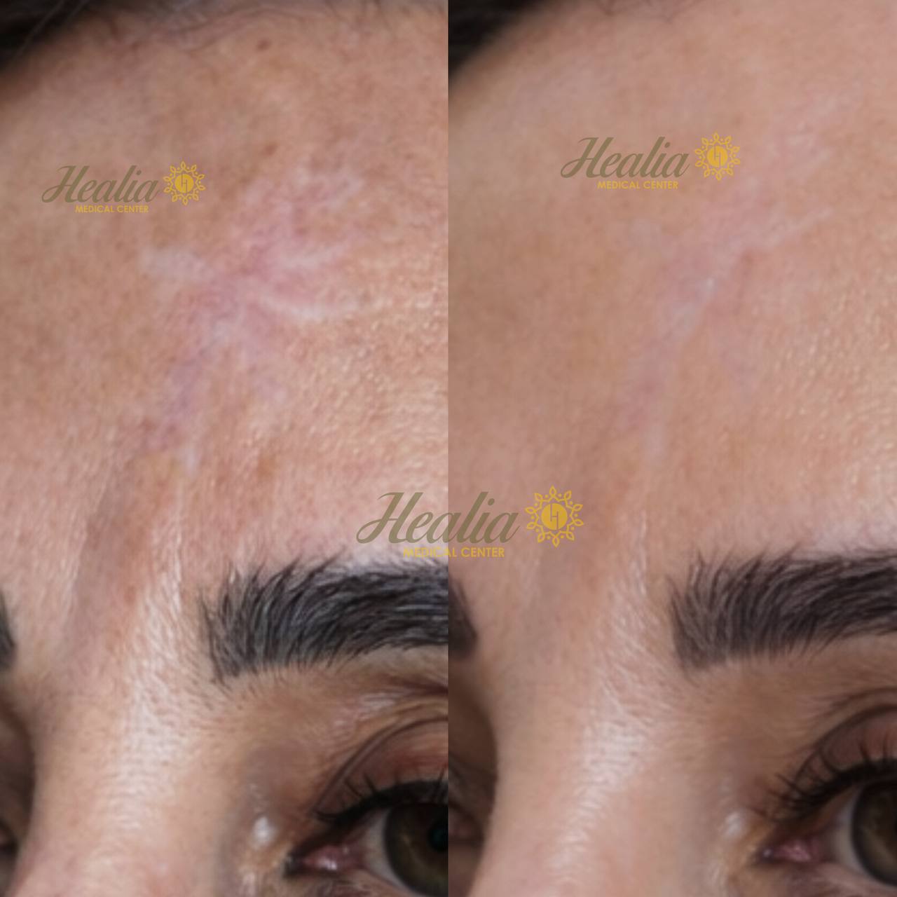 Scar Removal