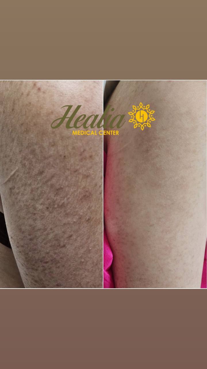 Scar Removal