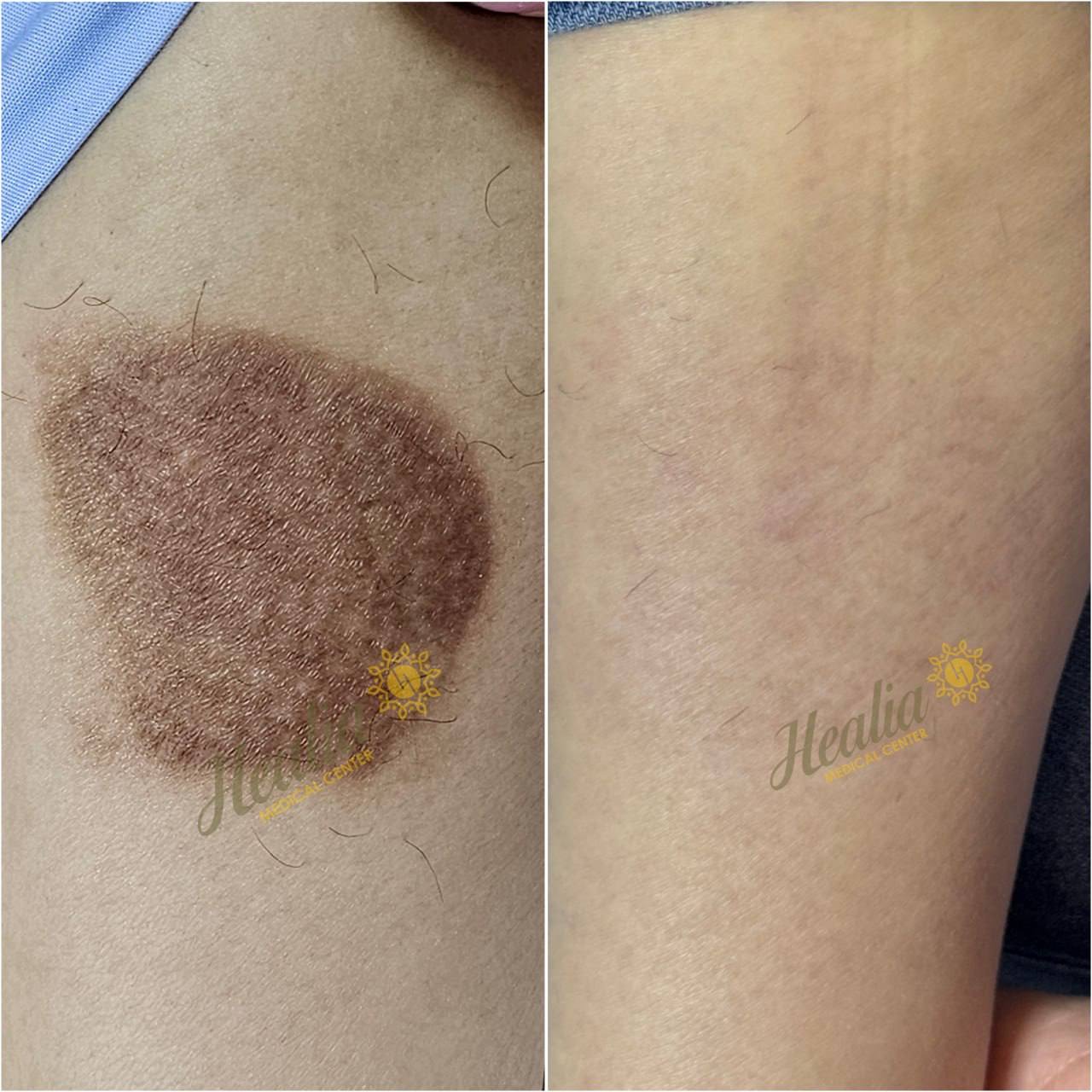 Scar Removal