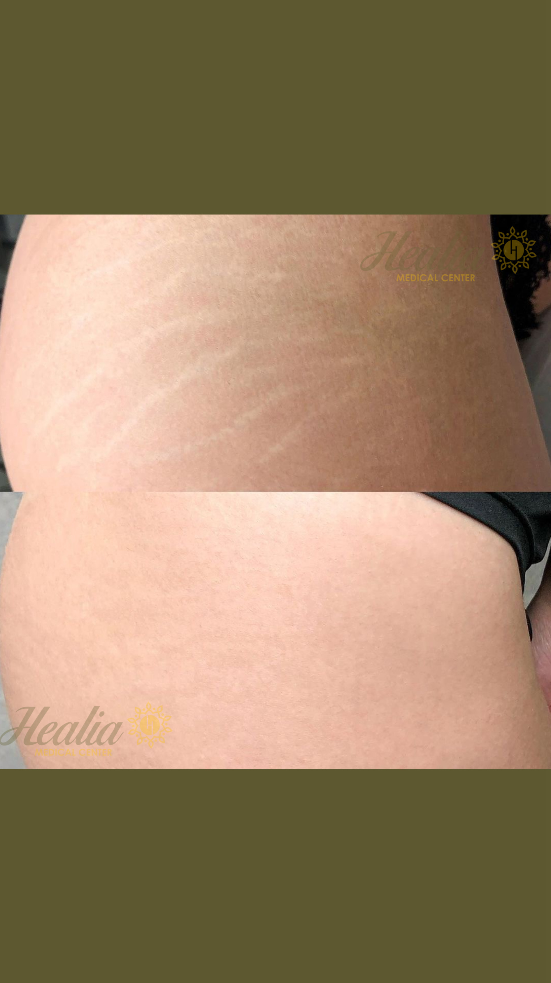 Stretch Marks