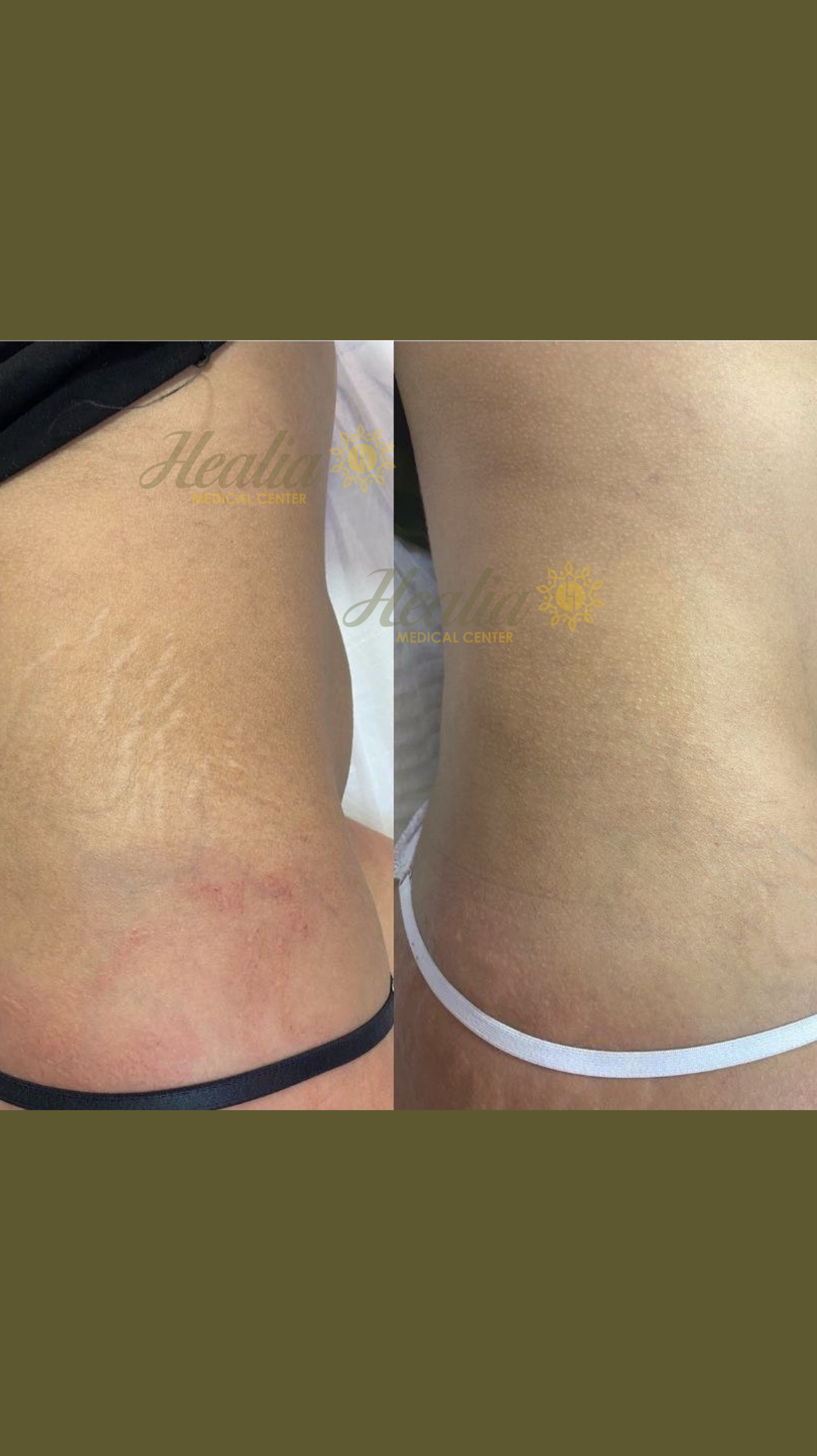 Stretch Marks