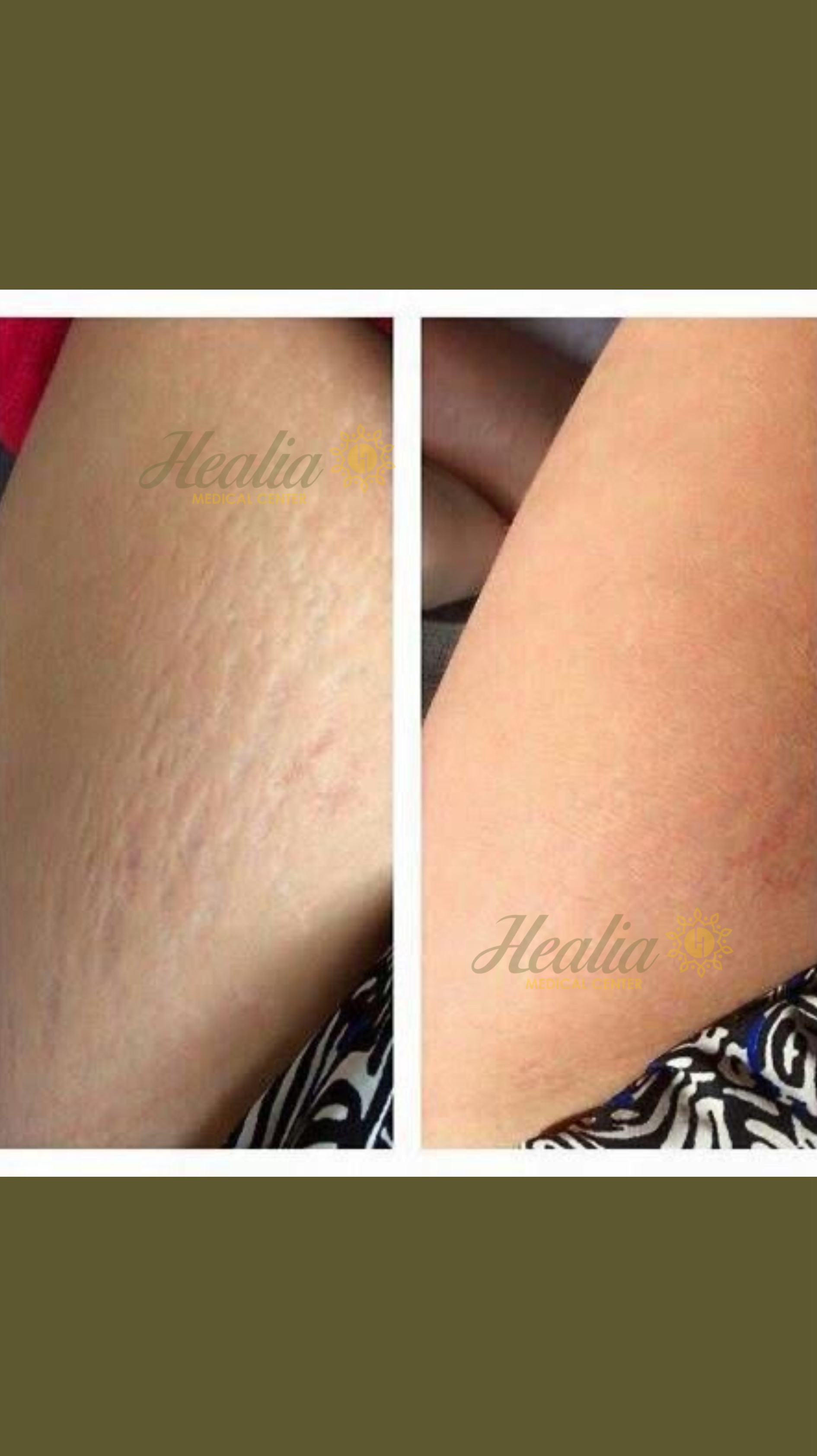 Stretch Marks