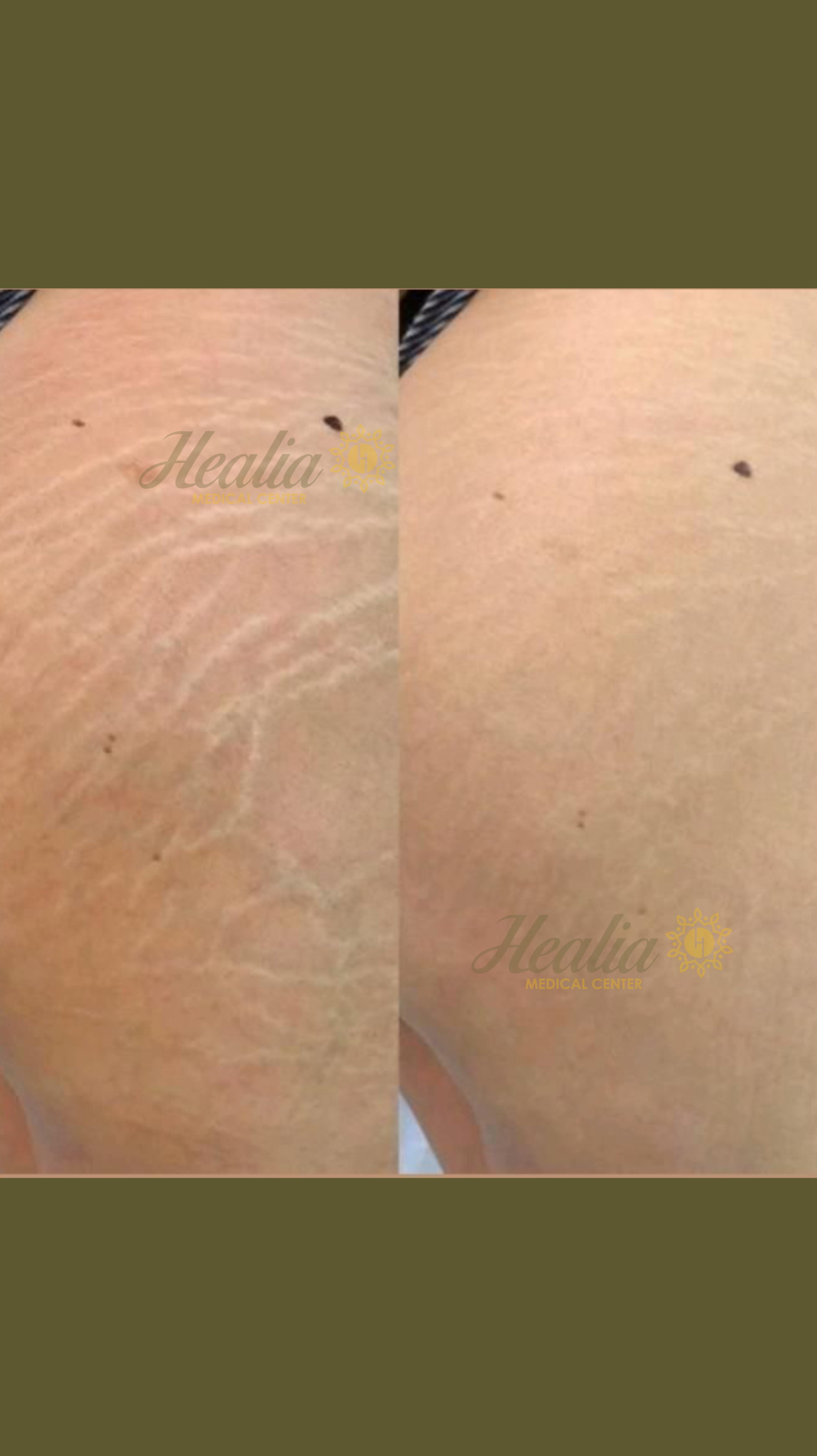 Stretch Marks