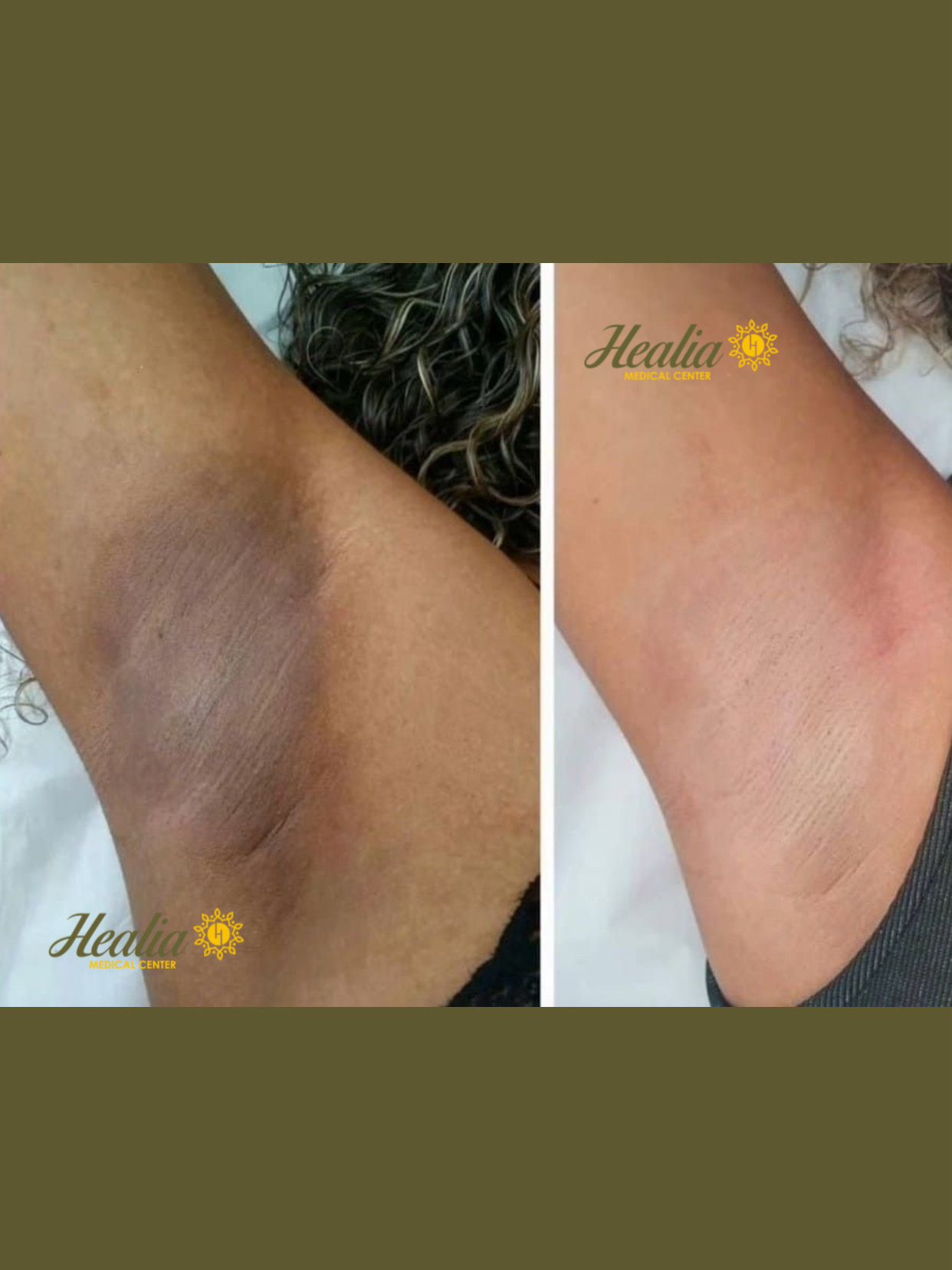 Underarm Lightening